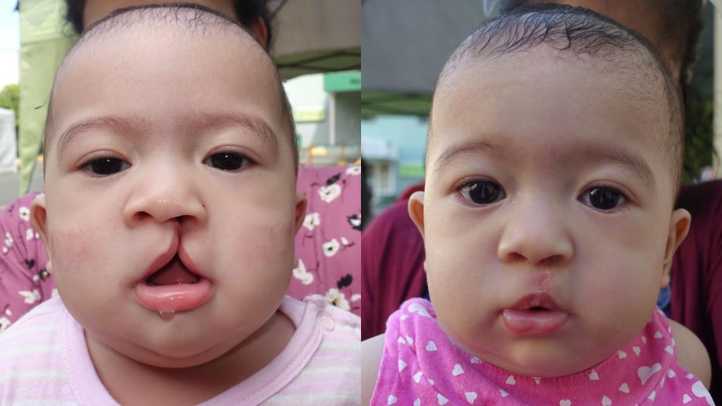 cleft palate and cleft lip before and after pictures