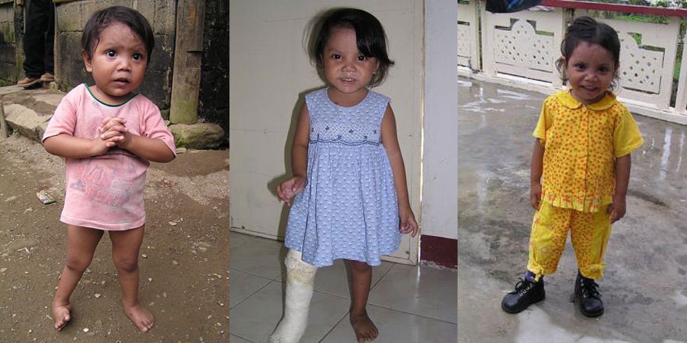 Club foot birth defect operated on at the ruel foundation
