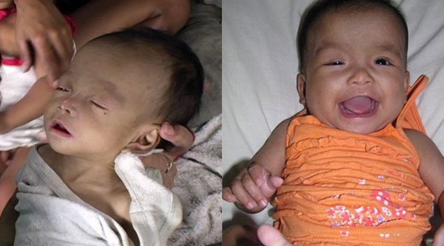 Miss I before and after care at malnourishment centre