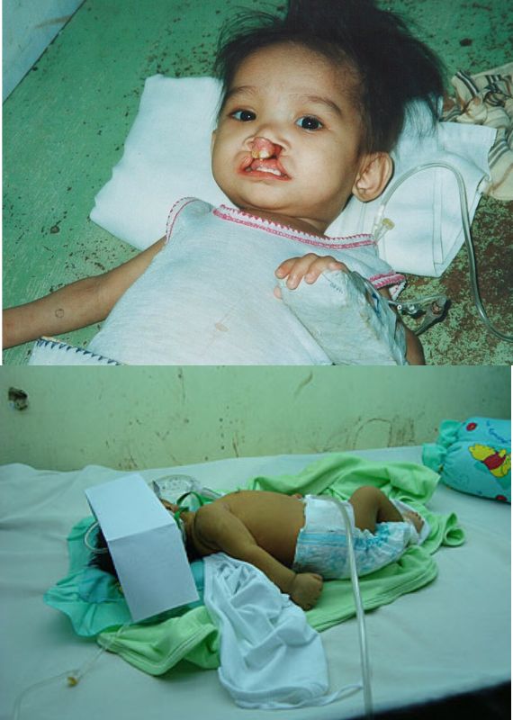 Ruel with cleft Lip and cleft palate